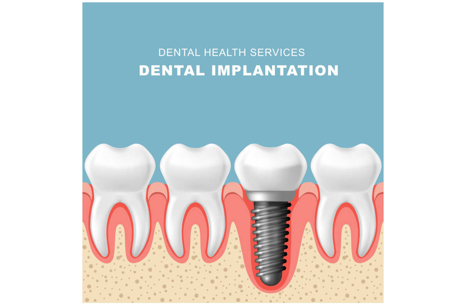 Is Uncovering Dental Implants Painful? │Chatham